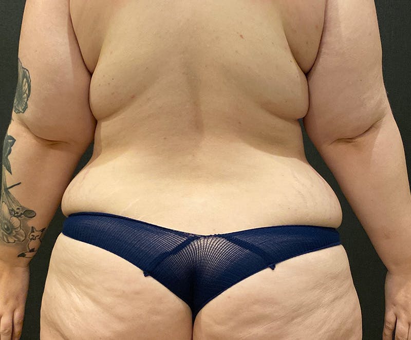 Tummy Tuck (Abdominoplasty) Before & After Gallery - Patient 134632 - Image 11