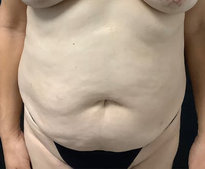 Tummy Tuck (Abdominoplasty) Before & After Gallery - Patient 321974 - Image 1
