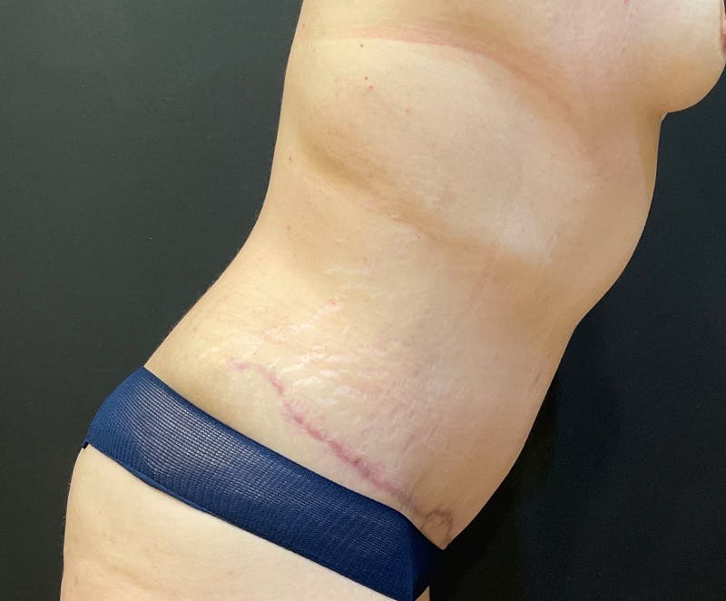 Tummy Tuck (Abdominoplasty) Before & After Gallery - Patient 134632 - Image 6