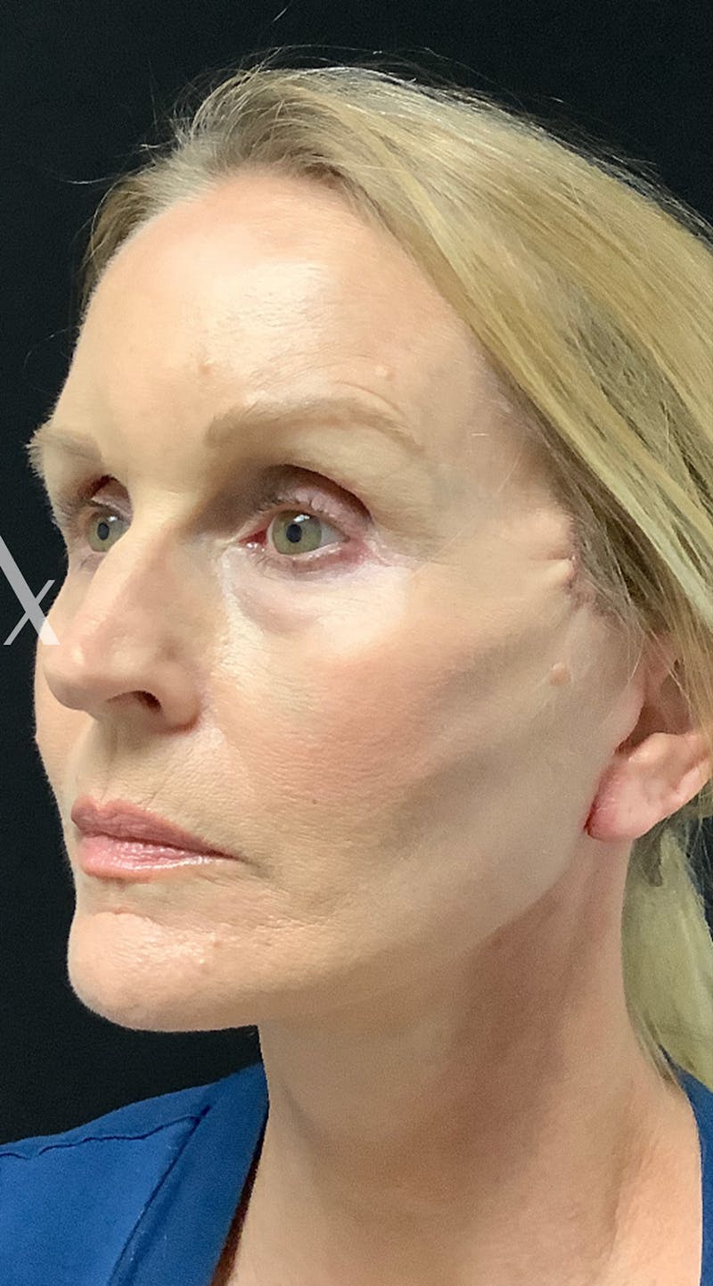 Facelift Before & After Gallery - Patient 208242 - Image 4