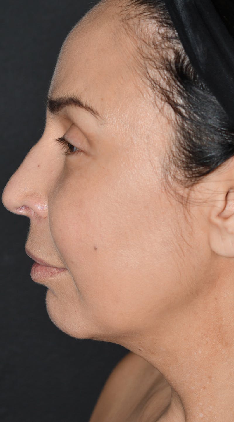 Facelift Before & After Gallery - Patient 326950 - Image 5