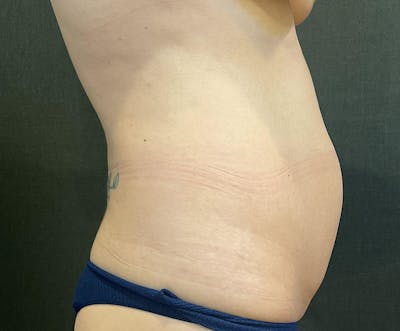 Tummy Tuck (Abdominoplasty) Before & After Gallery - Patient 393314 - Image 1