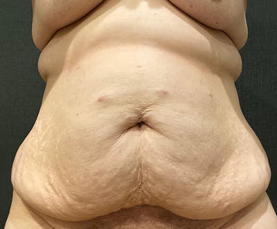 Tummy Tuck (Abdominoplasty) Before & After Gallery - Patient 134632 - Image 1