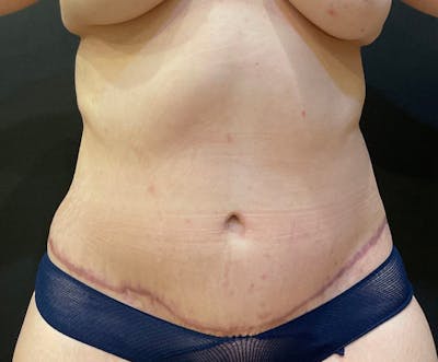 Tummy Tuck (Abdominoplasty) Before & After Gallery - Patient 134632 - Image 2