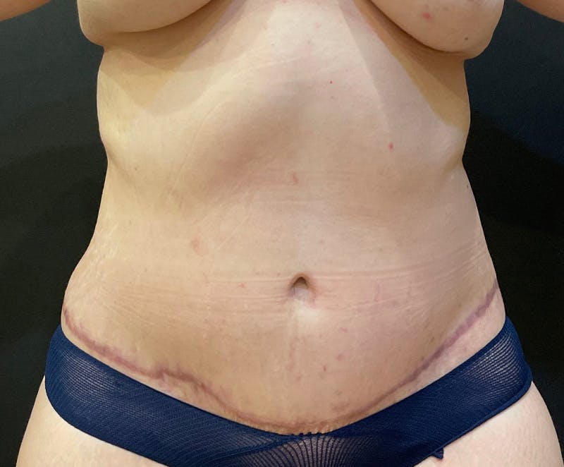 Tummy Tuck (Abdominoplasty) Before & After Gallery - Patient 134632 - Image 2