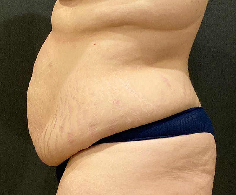 Tummy Tuck (Abdominoplasty) Before & After Gallery - Patient 134632 - Image 9