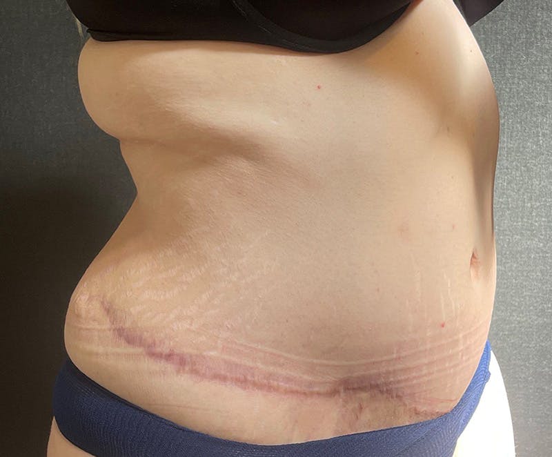 Tummy Tuck (Abdominoplasty) Before & After Gallery - Patient 134632 - Image 4