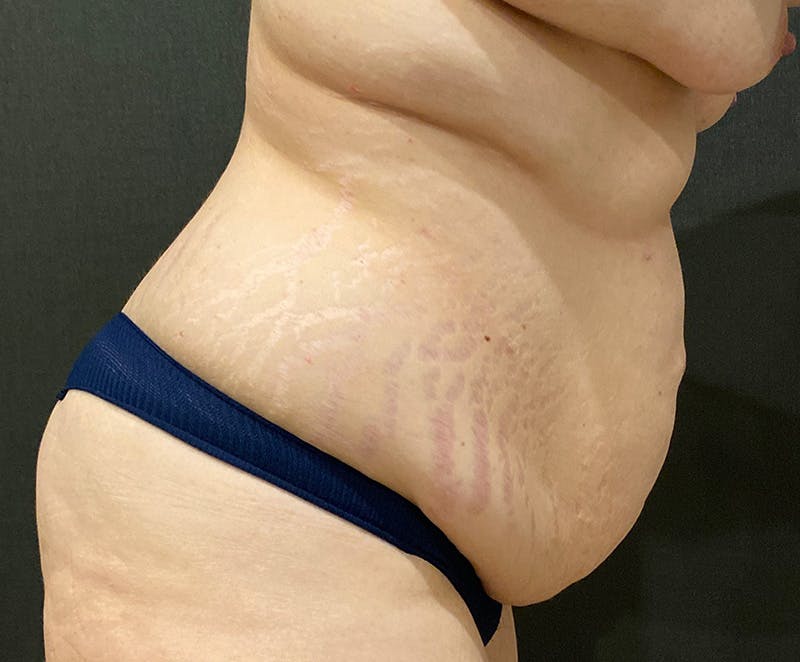 Tummy Tuck (Abdominoplasty) Before & After Gallery - Patient 134632 - Image 5