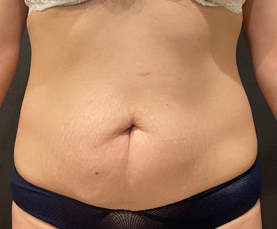 Tummy Tuck (Abdominoplasty) Before & After Gallery - Patient 232439 - Image 1