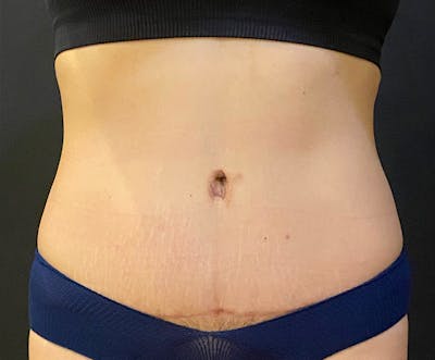 Tummy Tuck (Abdominoplasty) Before & After Gallery - Patient 232439 - Image 2