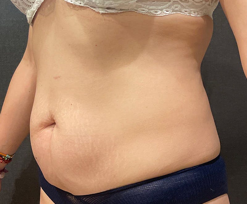 Tummy Tuck (Abdominoplasty) Before & After Gallery - Patient 232439 - Image 3