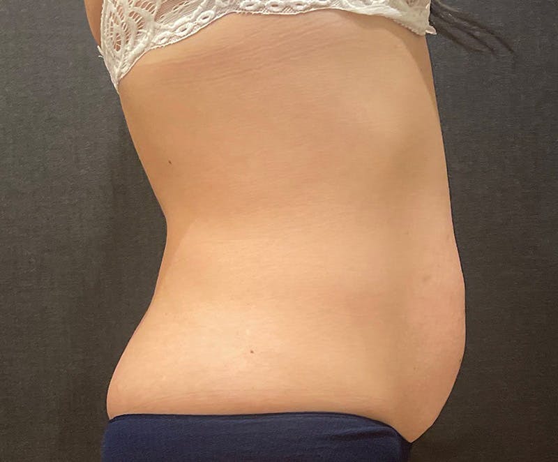 Tummy Tuck (Abdominoplasty) Before & After Gallery - Patient 232439 - Image 7