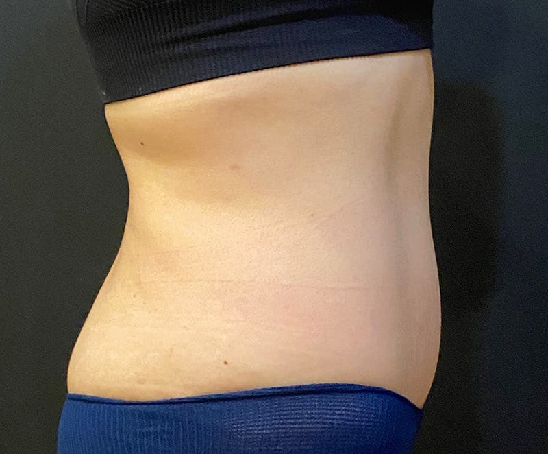 Tummy Tuck (Abdominoplasty) Before & After Gallery - Patient 232439 - Image 8