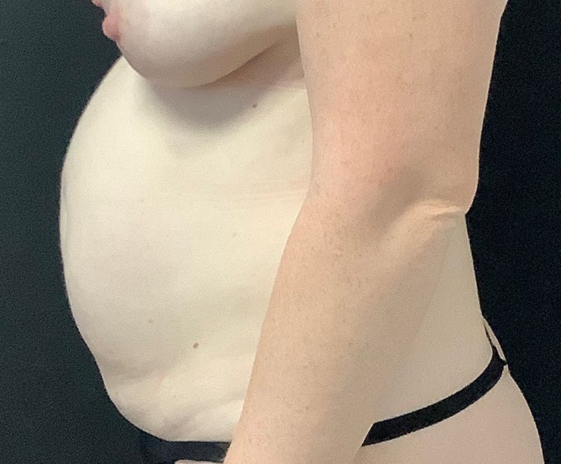 Tummy Tuck (Abdominoplasty) Before & After Gallery - Patient 104557 - Image 5