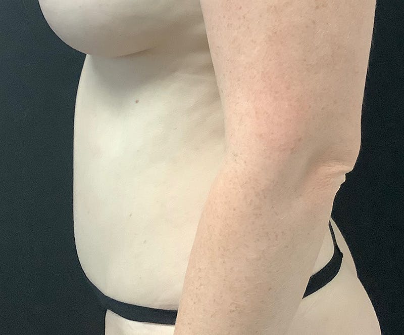 Tummy Tuck (Abdominoplasty) Before & After Gallery - Patient 104557 - Image 6