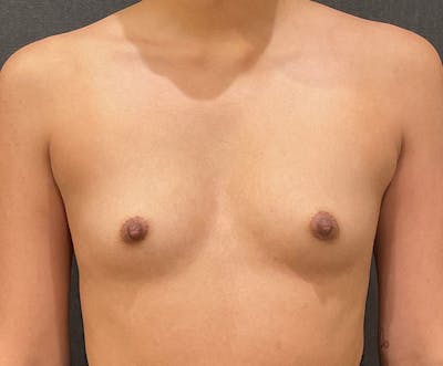 Breast Augmentation Before & After Gallery - Patient 338544 - Image 1