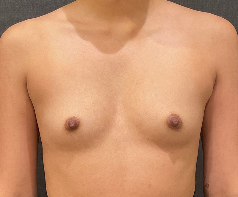 Breast Augmentation Before & After Gallery - Patient 338544 - Image 1