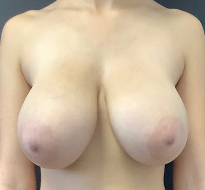Breast Reduction Before & After Gallery - Patient 314596 - Image 1