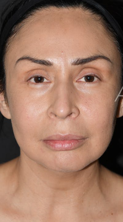 Facelift Before & After Gallery - Patient 326950 - Image 1