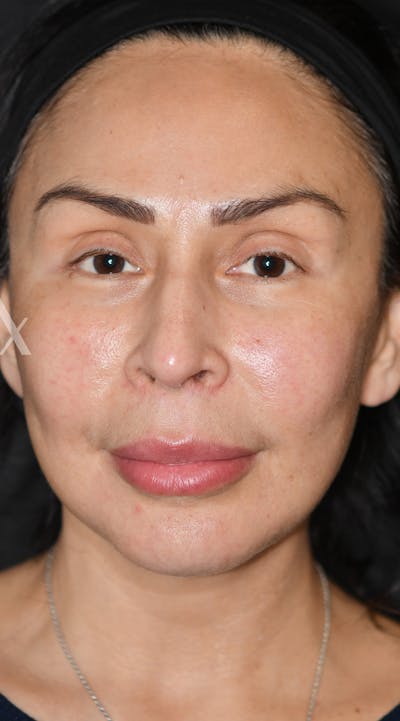 Facelift Before & After Gallery - Patient 326950 - Image 2