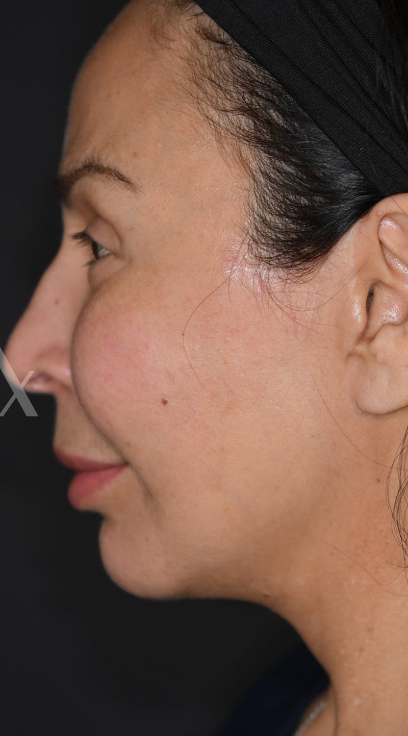 Facelift Before & After Gallery - Patient 326950 - Image 6
