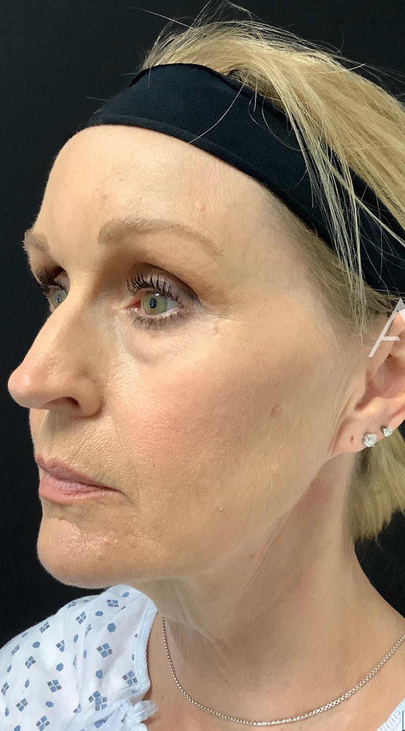 Facelift Before & After Gallery - Patient 208242 - Image 3