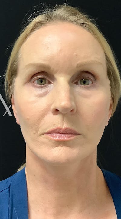 Facelift Before & After Gallery - Patient 208242 - Image 2