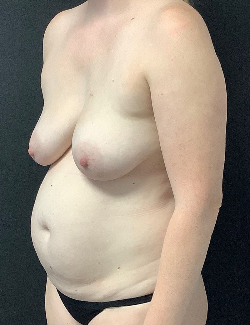 Mommy Makeover Before & After Gallery - Patient 233935 - Image 3