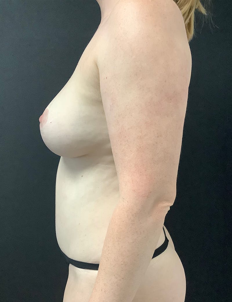 Mommy Makeover Before & After Gallery - Patient 233935 - Image 6