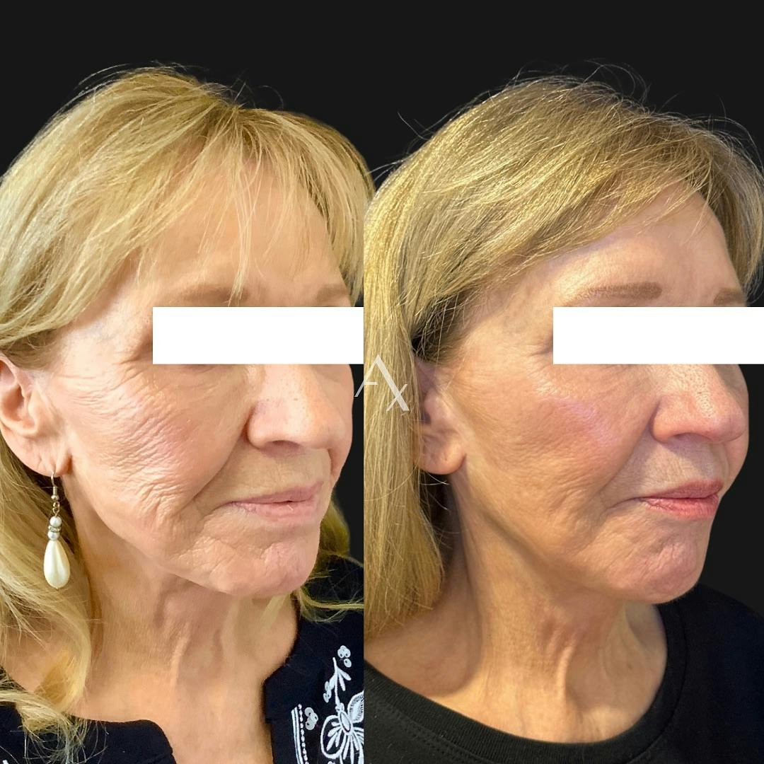 Before and after photo by Gigi, P.A. on Instagram