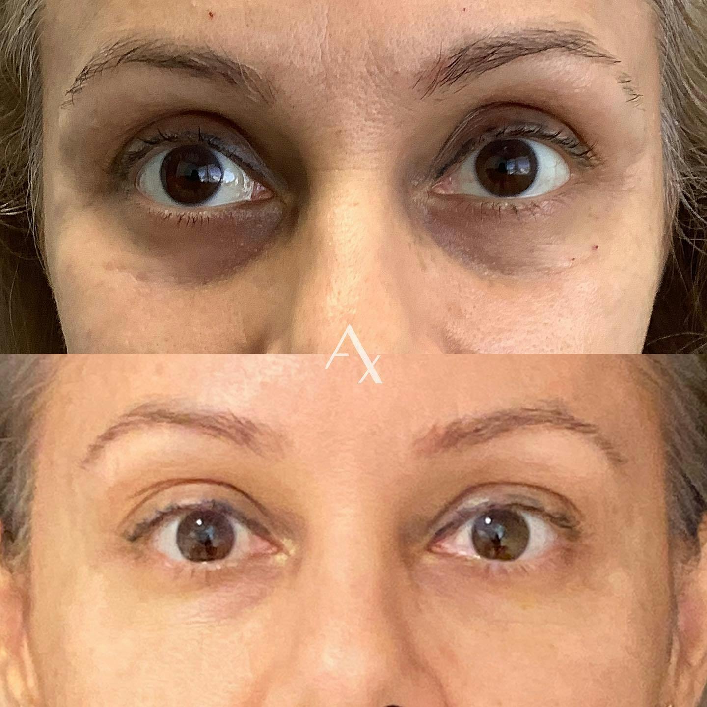 Before and after photo by Virginia, R.N. on Instagram