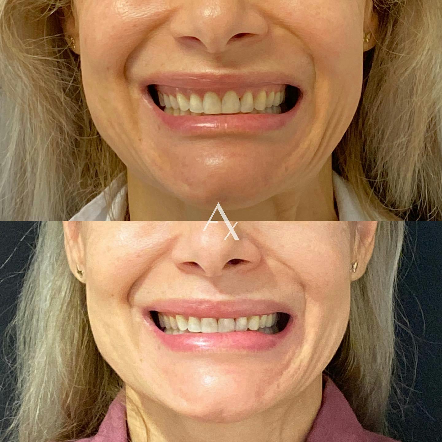 Before and after photo by Virginia, R.N. on Instagram