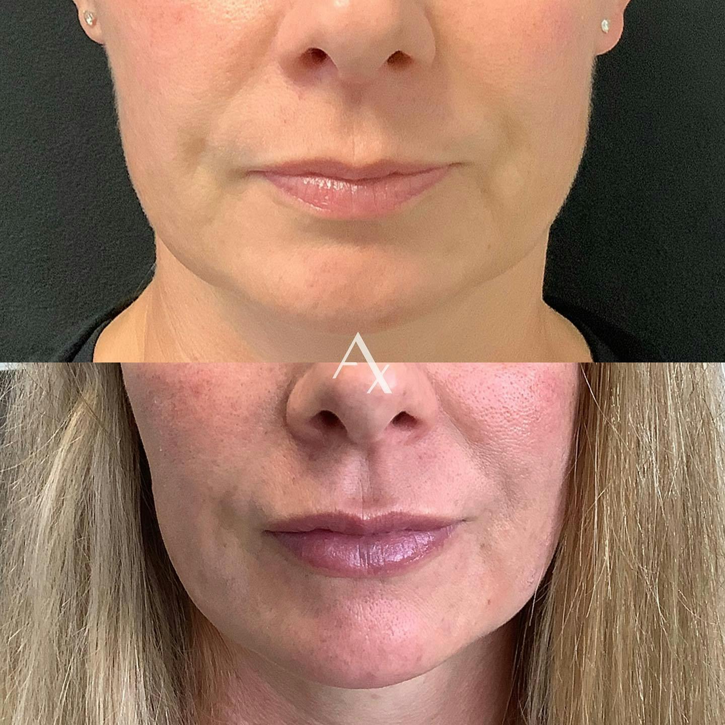Before and after photo by Virginia, R.N. on Instagram