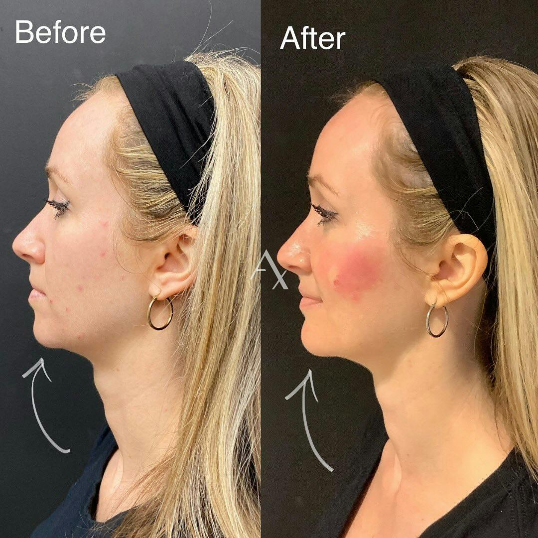 Before and after photo by Elaina, R.N. on Instagram