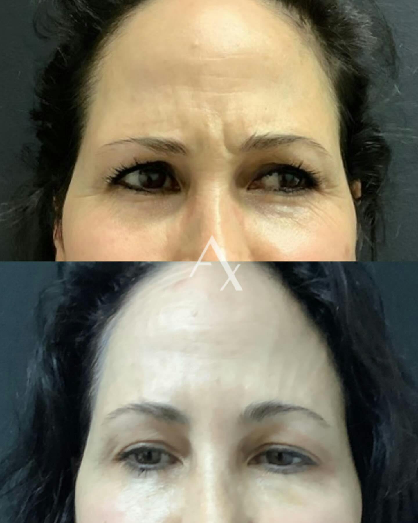 Before and after photo by Elaina, R.N. on Instagram