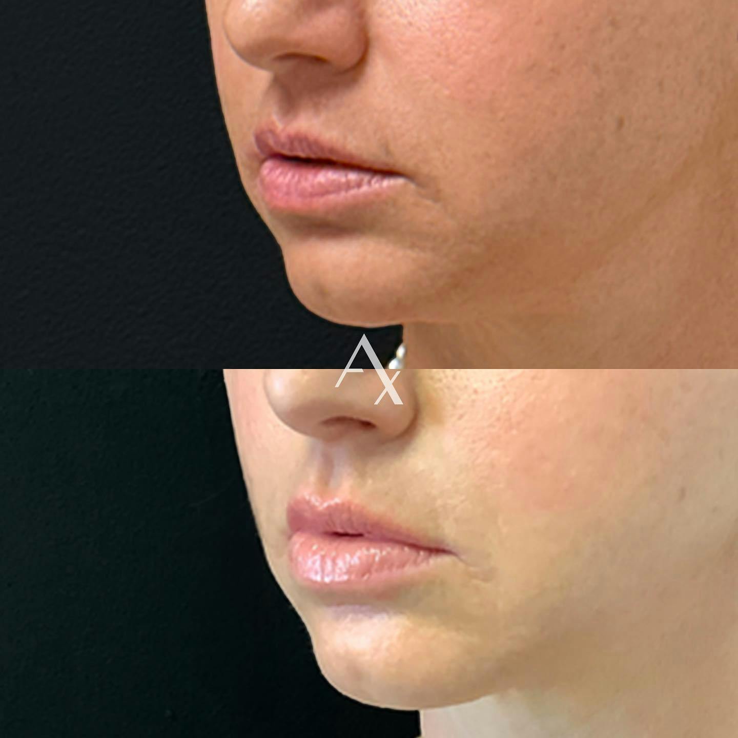 Before and after photo by Elaina, R.N. on Instagram