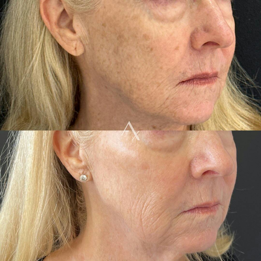 Before and after photo by Helen, R.N. on Instagram