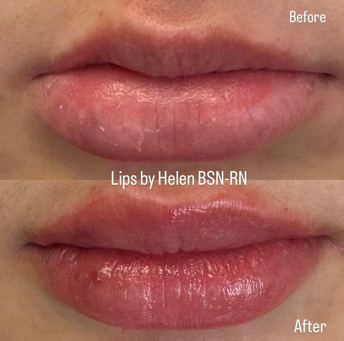 Before and after photo by Helen, R.N. on Instagram