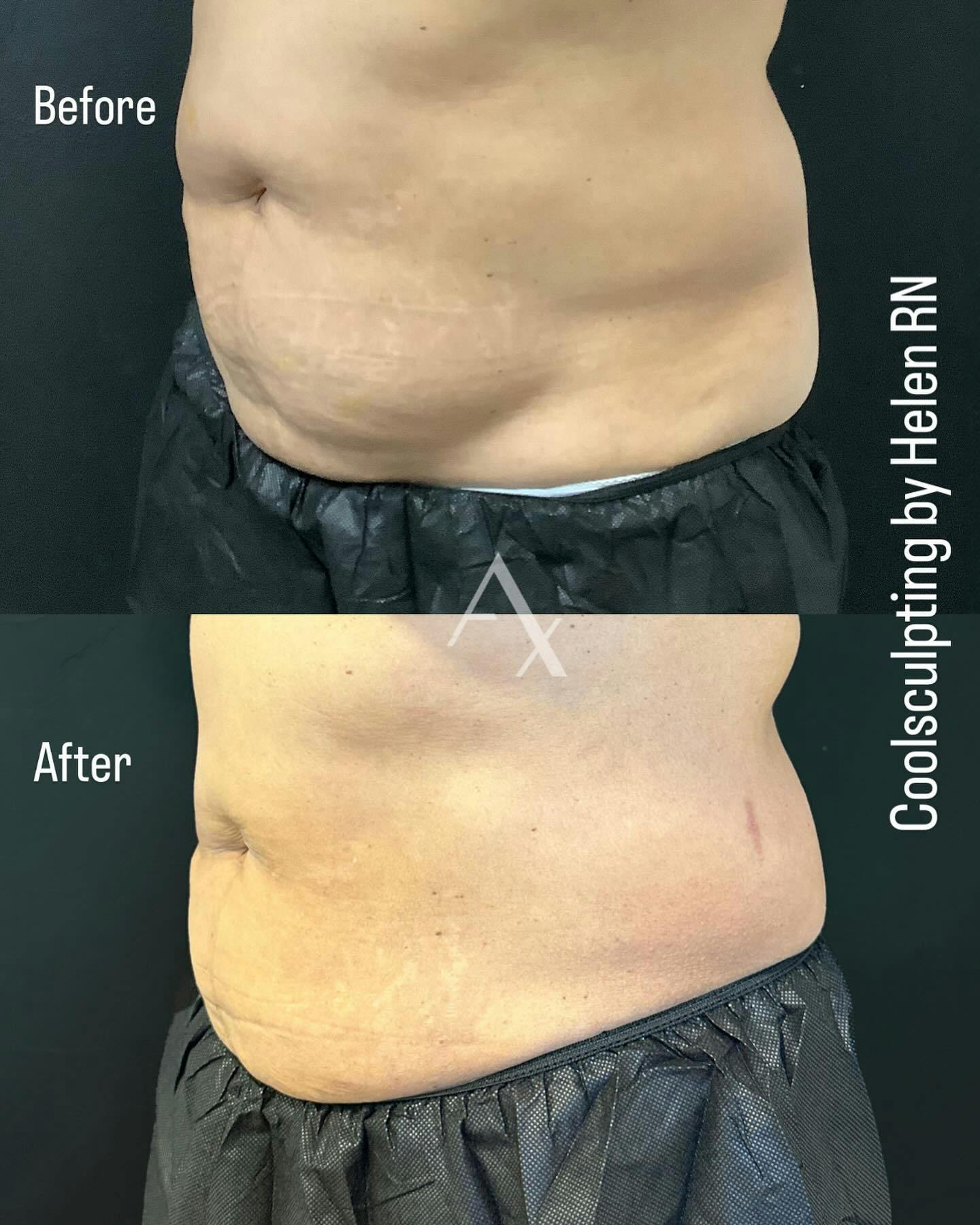 Before and after photo by Helen, R.N. on Instagram