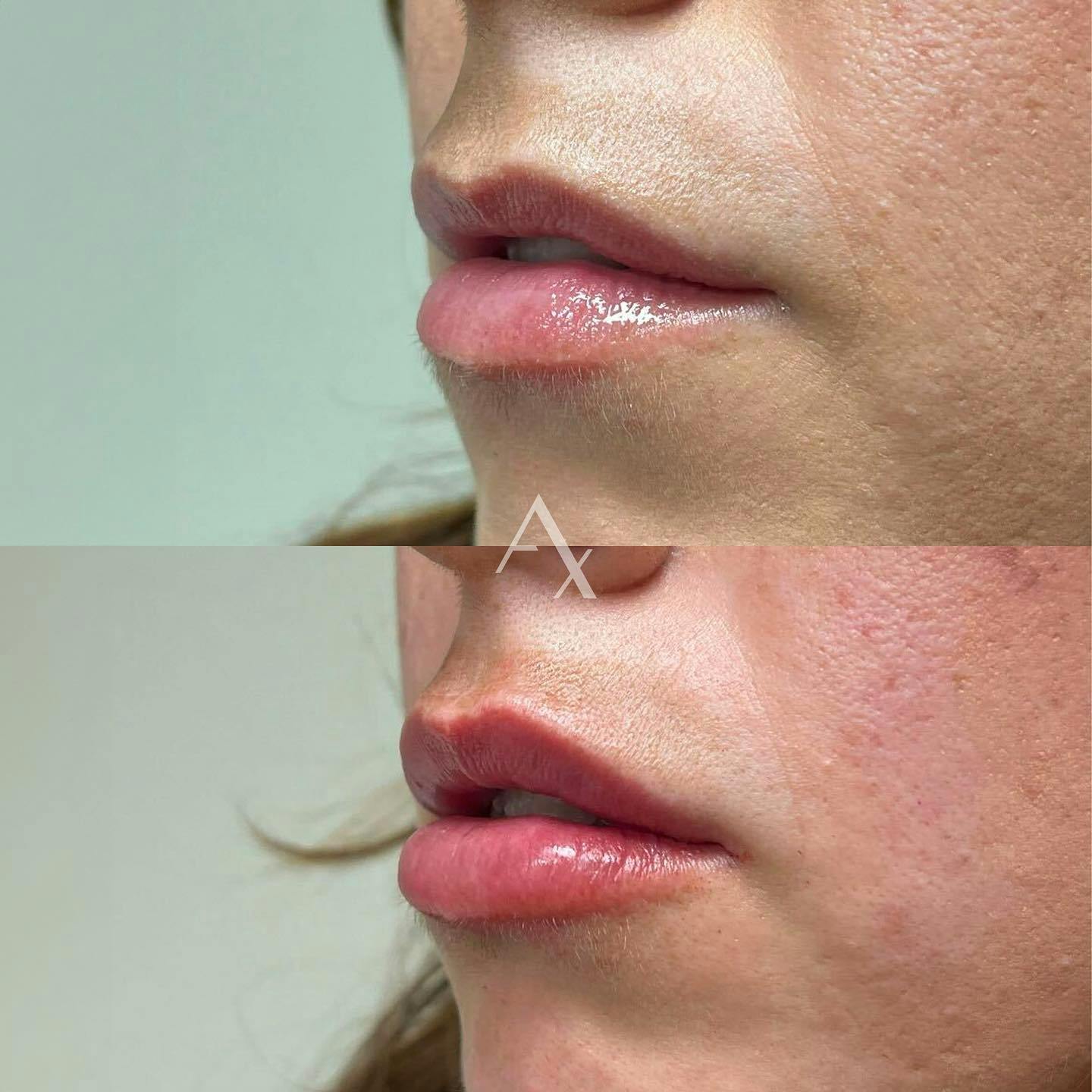 Before and after photo by Melissa, R.N. on Instagram