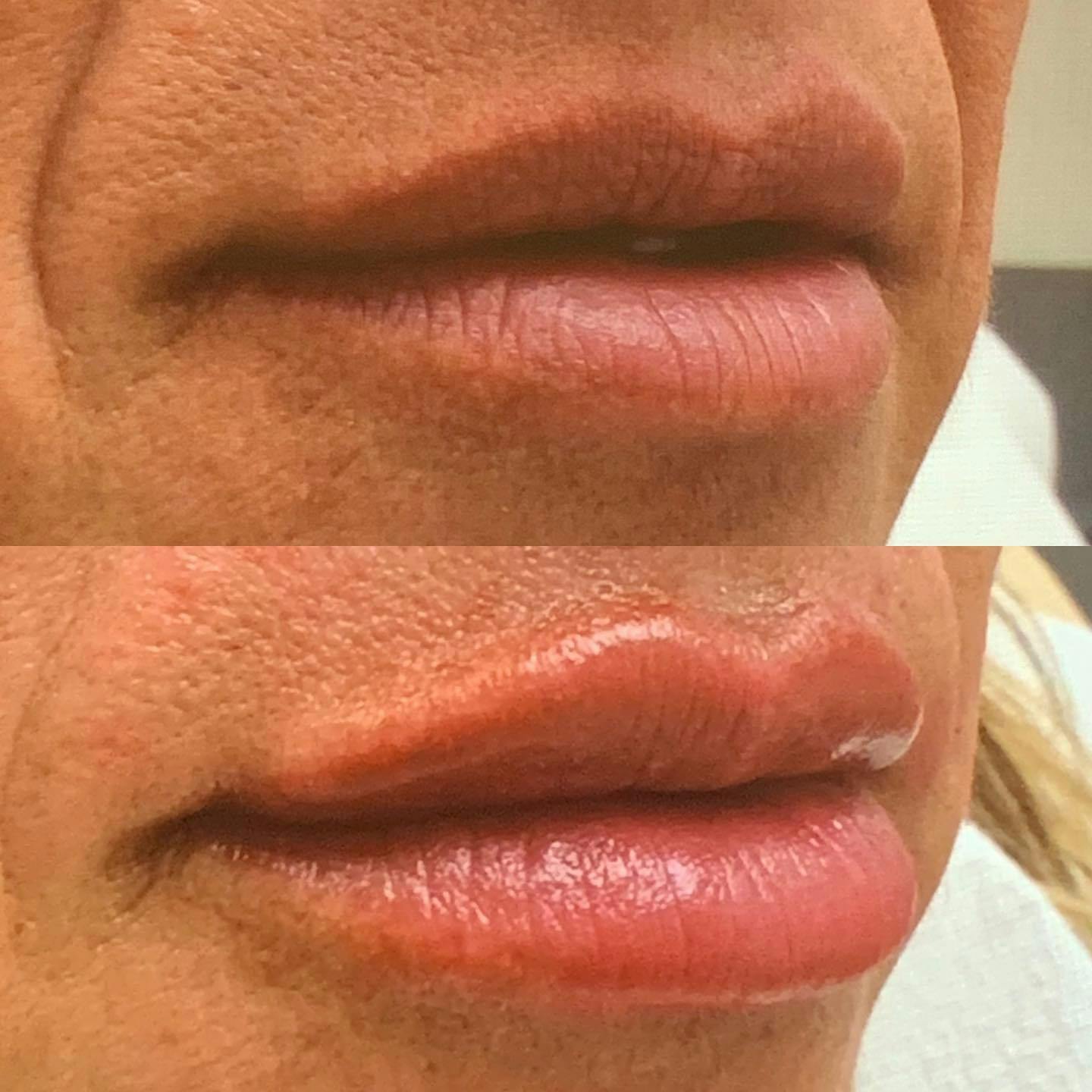 Before and after photo by Melissa, R.N. on Instagram