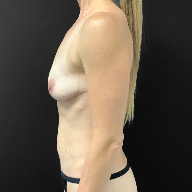 Breast Lift Before & After Gallery - Patient 292556 - Image 5