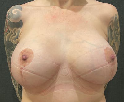Breast Lift Before & After Gallery - Patient 835325 - Image 2
