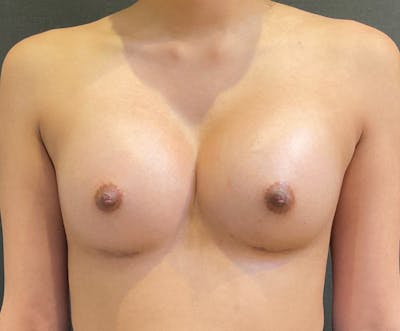 Breast Augmentation Before & After Gallery - Patient 338544 - Image 2