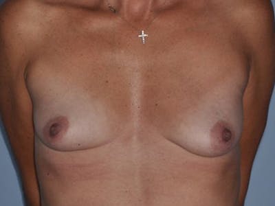 Breast Augmentation Before & After Gallery - Patient 410104 - Image 1