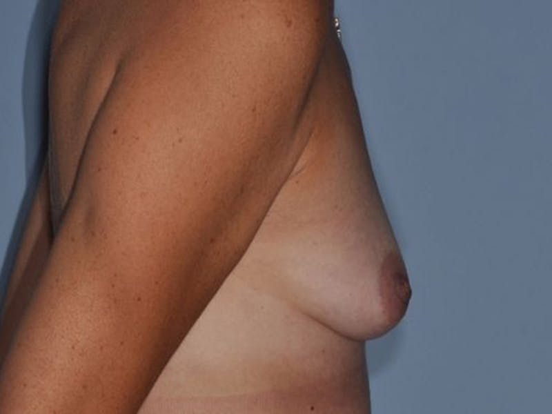 Breast Augmentation Before & After Gallery - Patient 410104 - Image 5