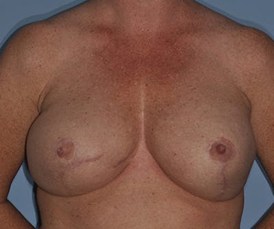 Breast Reconstruction Before & After Gallery - Patient 408921 - Image 2