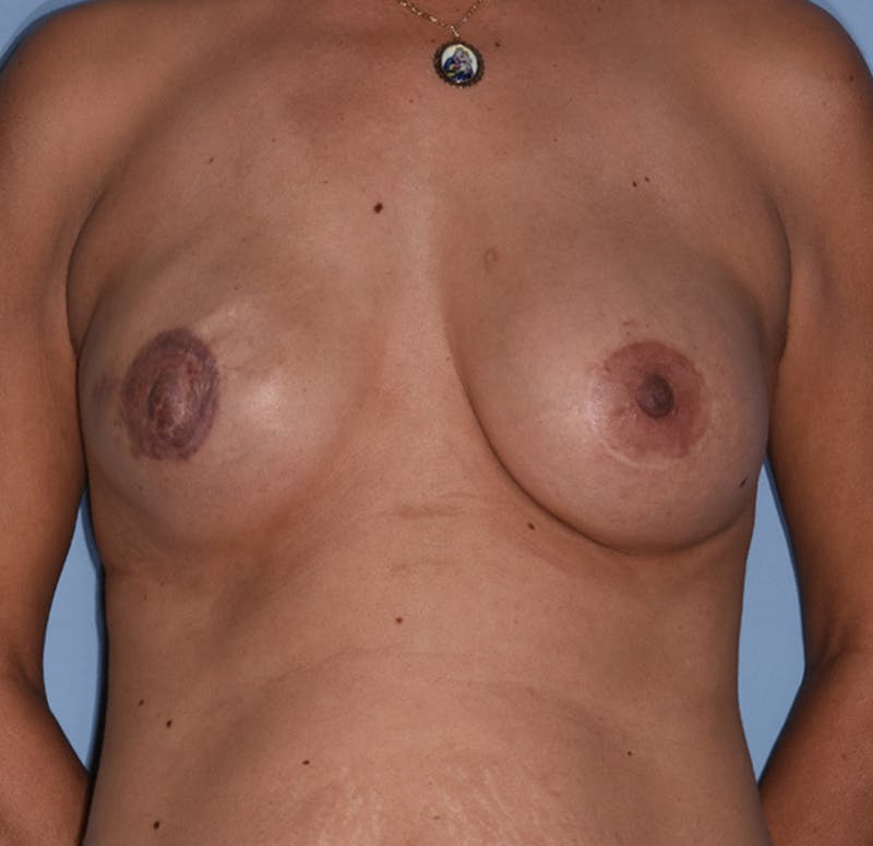 Breast Reconstruction Before & After Gallery - Patient 101442 - Image 1