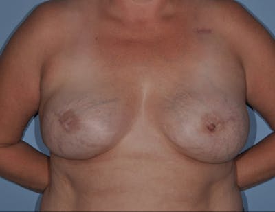 Breast Reconstruction Before & After Gallery - Patient 186162 - Image 2