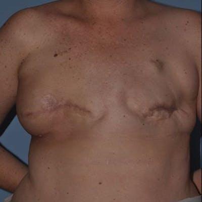 Breast Reconstruction Before & After Gallery - Patient 873748 - Image 1